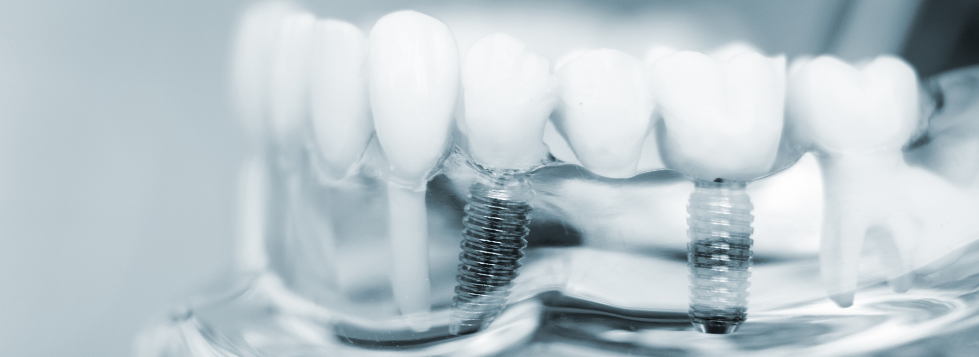 Patchogue Implants Dentist